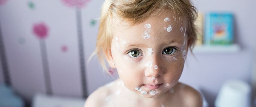 Molluscum Contagiosum