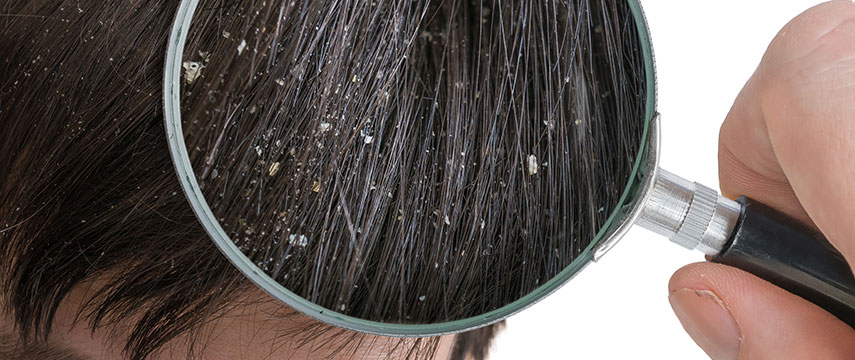 Caspa: como prevenir e tratar