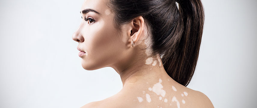 Dia Mundial do Vitiligo