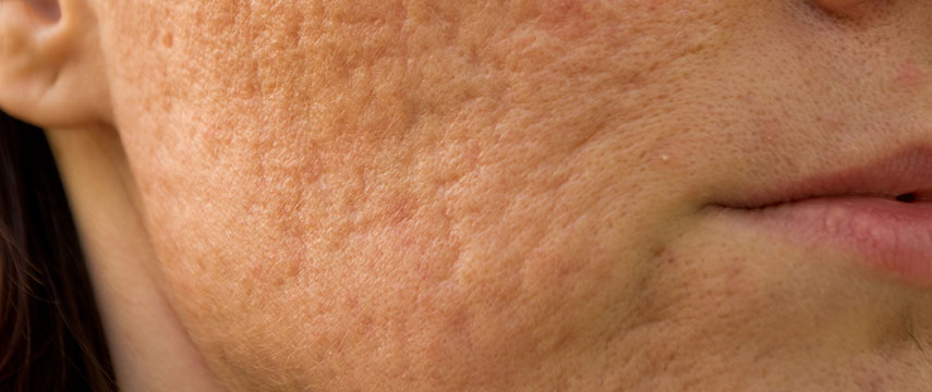 Cicatrizes de Acne e Outras