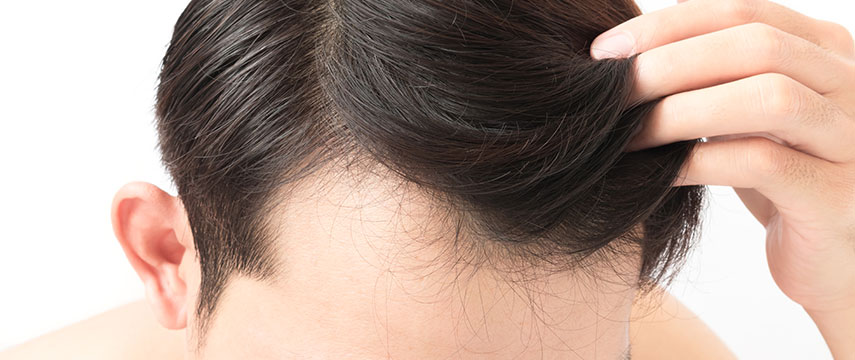 Hair Loss - MMP