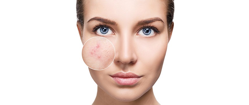 A acne nas mulheres