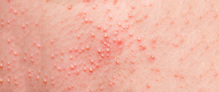 Brotoejas nas crianças: o que são, como prevenir e evitar