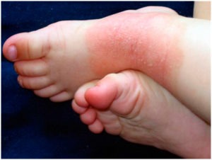 clinica-natalia-cymrot-dermatite-atopica