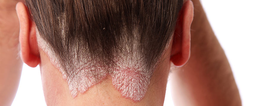 Psoríase, guia definitivo