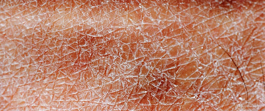 Ressecamento da pele como efeito colateral de medicamentos