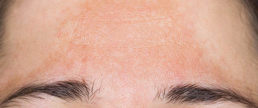 Dossiê Manchas na Pele: fique atento ao Melasma
