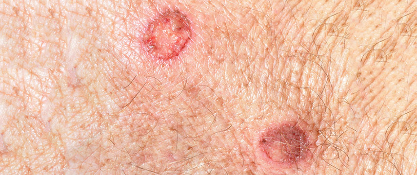 O que é a Queratose actínica da pele?