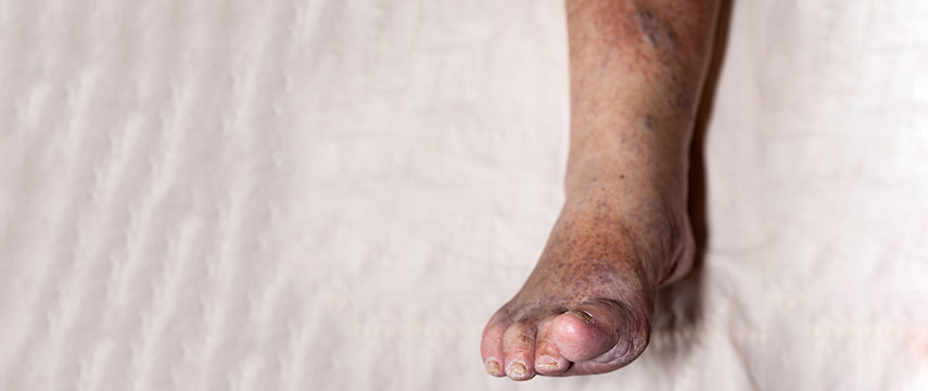 As varizes e a dermatite