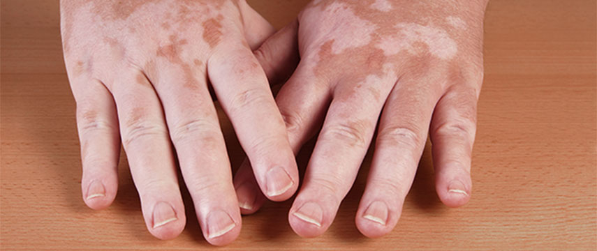 O Vitiligo tem cura?
