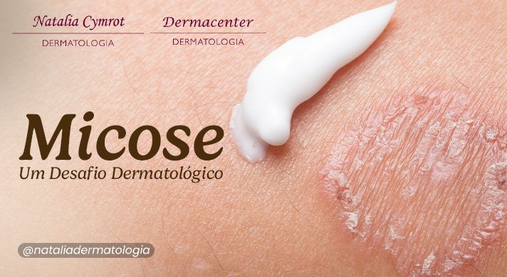 A imagem mostra uma micose de pele e ao lado uma pequena quantidade de creme branco