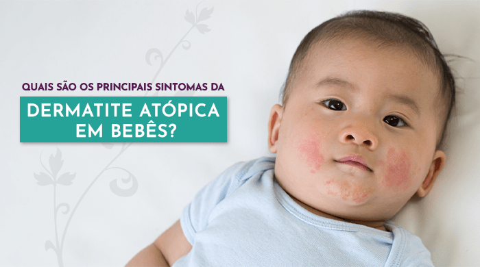 Bebê com manchas vermelhas nas bochechas, sugerindo sinais de dermatite ou alergia na pele, deitado sobre uma superfície branca, com expressão tranquila.