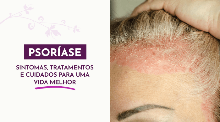 Pessoa com couro cabeludo irritado e descamado, evidenciando sintomas de uma condição dermatológica, com foco na região próxima à testa.