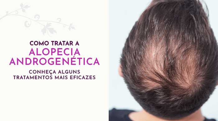 Homem com calvície vista de cima ao lado de um banner informativo sobre alopecia androgenética e tratamentos eficazes oferecidos pela Dra. Natalia Cymrot.