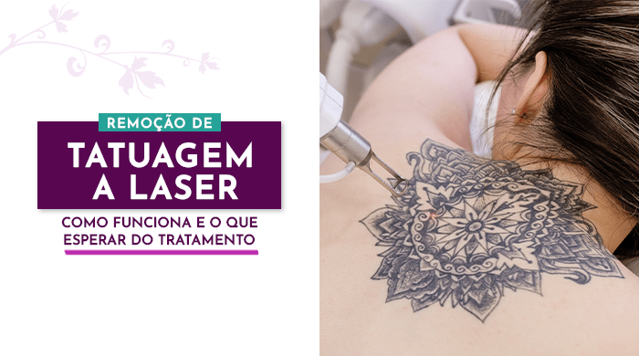 Pessoa deitada de costas realizando remoção de tatuagem nas costas com aplicação de laser sobre desenho em preto detalhado.